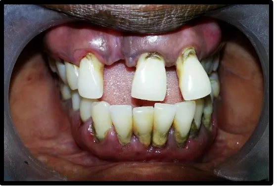 Figure 3: Chronic generalised periodontitis Pre-operative 3 