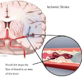 Figure 2.1 An Ischemic Stroke occurs when an artery to the brain is blocked by a blood clot (Source: Heart and Stroke Foundation of Canada, 2008) 