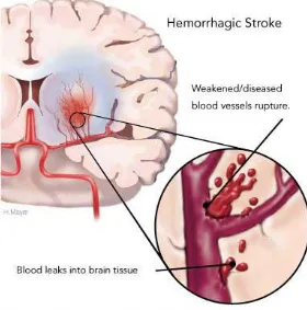 Figure 2.2: A Hemorrhagic Stroke occurs when a blood vessel ruptures and bleeds into the brain