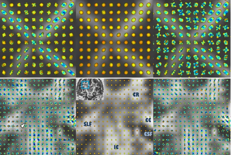Fig.  4.   Reconstructed ODFs from rat spinal cord phantom (top) and human brain (bottom), shown on the GFA map, using:  (left) our  proposed technique,  (middle) original QBI after normalization,  and (right) original QBI with Laplace-Beltrami sharpening