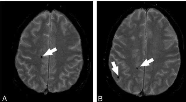 Fig 1. MR axial images that demonstrate the presence of CMBs. The white arrows indicate the CMBs.