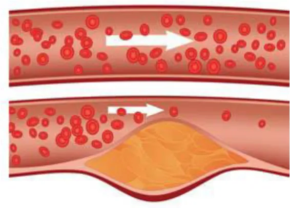 Fig 3. Blockage of arteries 