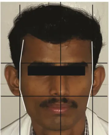 Fig.7 SQUARE FACIAL FORM- DENTULOUS SUBECT 