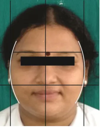 Fig. 10 OVOID FACIAL FORM- DENTULOUS SUBECT 