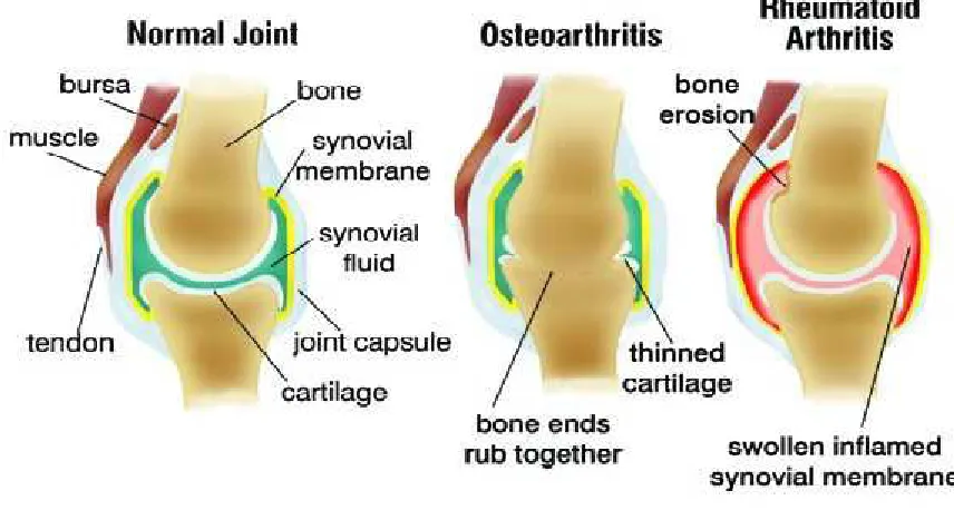 Figure no. 22 Osteoarthritis bone