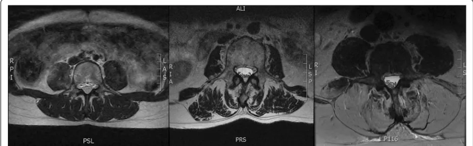 Fig. 1 T2 weighted axial MR images of the lumbar spine. Images represent Kjaer grade [16] 0 (left), 1 (center), and 2 (right) muscles of the lumbarspine