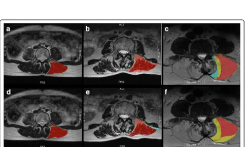 Fig. 3 Examples of overlapping regions of interest defined by all 3 raters (red), 2 raters (yellow), or 1 rater (blue) for the multifidus muscle usingregion of interest definitions from method 1 (a-c) and method 2 (d-f) for muscles with Kjaer grade 0 (a, d), 1 (b, e), and 2 (c, f)