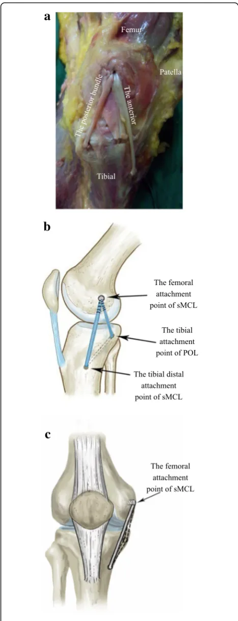 Fig. 2 Triangular reconstruction of the sMCL and POL. The femoralattachment site of the reconstructed sMCL is the sMCL anatomicalattachment point