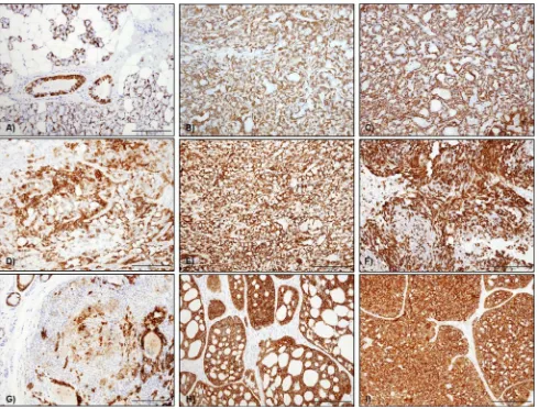 Fig. 3  CK14 staining in salivary gland tumours a in normal tissue CK14 staining was mainly seen as a cytoplasmic staining of myoepi-thelial cells surrounding acini and in some basal cell in ducts, b CK14 in ACC was variable with one case showing difuse ablumi-nal staining, c CK14 in one SC with difuse cytoplasmic staining of abluminal cells, d CK14 staining in PA was predominantly seen in the cytoplasm of most tumour cells, but plasmacytoid cells were 