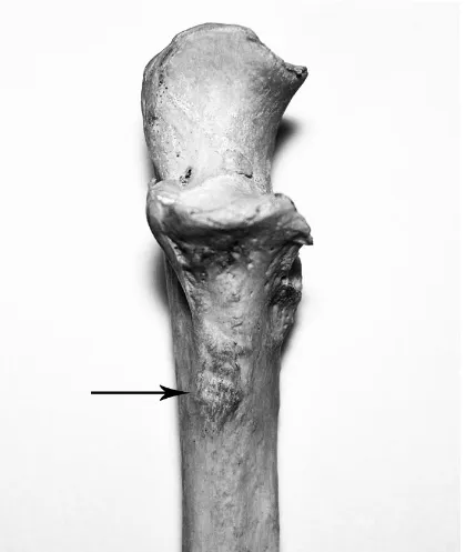 Figure 3. Normal development of the M. brachialis direct fibrous insertion on the anteroproximal diaphysis of the ulna, inferior to the coronoid process