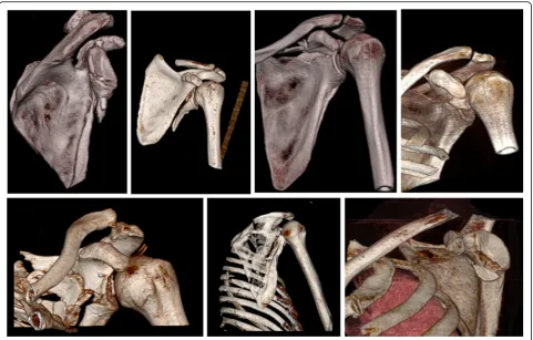 Fig. 1 Examples of glenoid fractures and in combination with the scapular body and neck