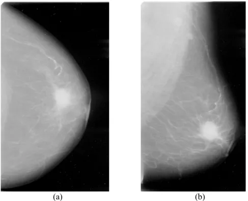 Figure 2.4: Example of mammogram image for (a) CC view (b) MLO view 