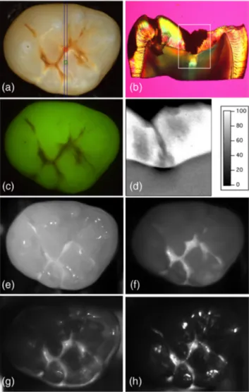 Fig. 3 Images of a tooth from group 1 with demineralization in the fissure. (a) visible (color), (b) PLM image cut at the position of the two thin blue lines in (a), (c) QLF, TMR measurements of % mineral compared to sound enamel for the region marked in t
