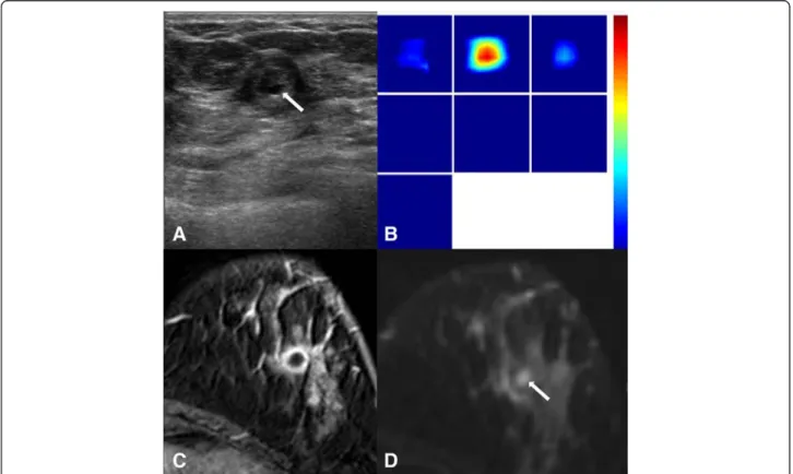Table 3 The mean and standard deviation of US-DOT and DCE- DCE-MRI parameters in the 37 breast cancers
