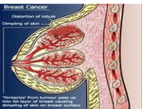 Figure 1.1  Breast cancer 