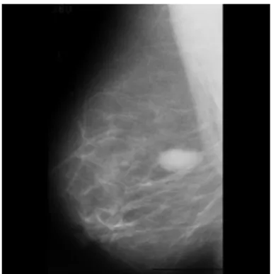 Figure 3.3  Mammogram image 