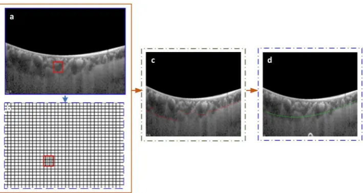 Figure 11. Result of Choroid Layer Segmentation using deep learning method: (containing an OCT image being labeled by the doctor, where BM is marked in green and choroid is marked in red