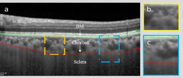 Figure 1. he challenges being faced by the segmentation of choroid layer: (with ground truth being marked by the specialist