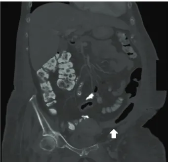Figure 1: CT of the abdomen/pelvis showing mild wall thickeningand an ahaustral appearance of the distal colon with pericolonic fatstranding consistent with colitis.