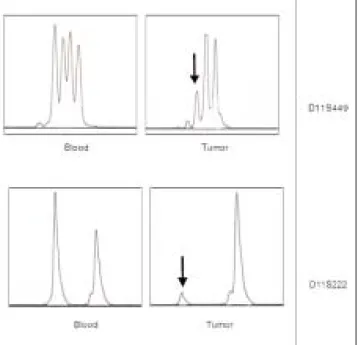 Figure 1 - Microsatellite length polymorphisms around MEN1 locus ana- ana-lyzed using polymorphic DNA markers on chromosome 11q13 in MEN 1 family