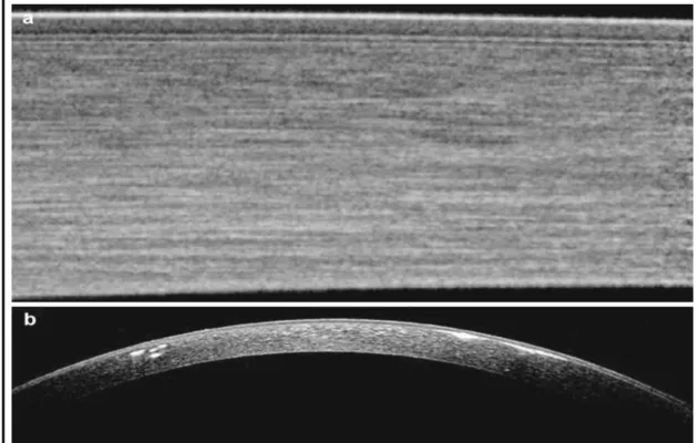 Figure 1.4: Spectral domain of the Anterior Segment Ocular Coherence  Tomography (SD-OCT) images: (a) Normal cornea and (b) Avellino corneal 