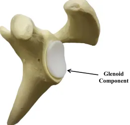 Figure 1.3: Total Shoulder Arthroplasty Glenoid Component