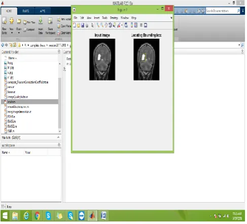 Figure 2: Tumor detection from the MR image 