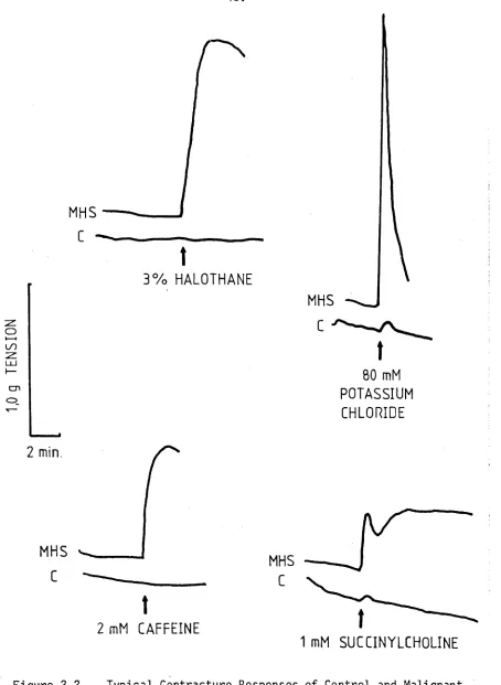 Figure 2.2 Typical Contracture Responses of Control and Malignant 
