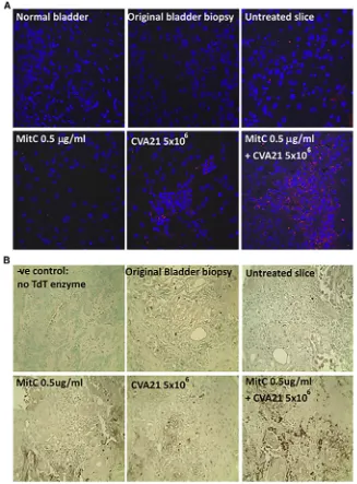 Figure 4. Enhanced Cytotoxicity of Mitomycin-C andCVA21 on Bladder Cancer Tumor Slices