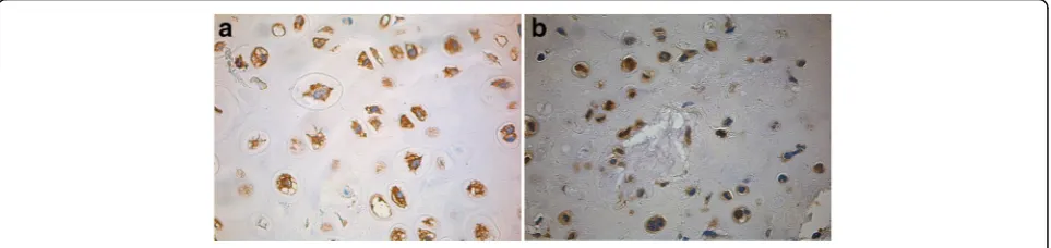 Fig. 1 Examples of positive staining for MMP-1 (a) and MMP-9 (b) in two grade 2 chondrosarcomas