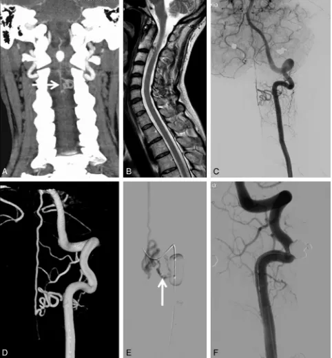 Fig 4. A 52-year-old woman with an incidental cervical SDAVF.of the vertebral artery. A, CT angiography of the carotid arteries performed for suspected carotid stenosis shows dilated perimedullary veins atthe C2-C3 level