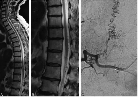 Fig 5. A 71-year-old man with nonspecific lower back pain. A and B, T2-weighted MR imaging shows dilated perimedullary veins around the conus and lower cord without myelopathy.C, Spinal angiography shows an SDAVF at the right T8 level.