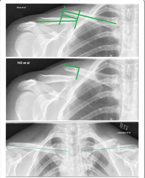 Fig. 1 The three methods for measuring post-fracture clavicularlength compared in this study