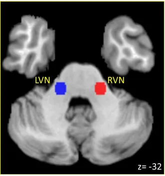 Figure 3.1 Vestibular Nuclei Seed Regions-of-Interest. Left (LVN) 
