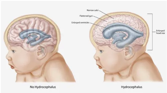 Figure 1: A common feature of infantile hydrocephalus is a large head circumference which can be accredited to an increase in intraventricular pressure leading to ventricular dilatation (VD) and consequently an increase in head circumference (From: Hydroce