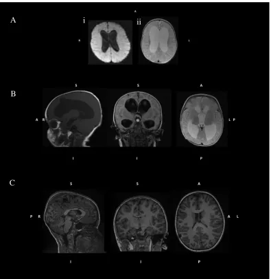 Figure 6: The structural MRI images of patient 2A, just before their VP shunt insertion (A, B) and years after surgery (C)