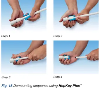 Fig. 18 Demounting sequence using HepKey Plus ™