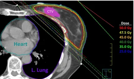 Figure 1.2: Axial view of a left-sided whole breast radiotherapy plan using two parallel and opposing IMRT beams