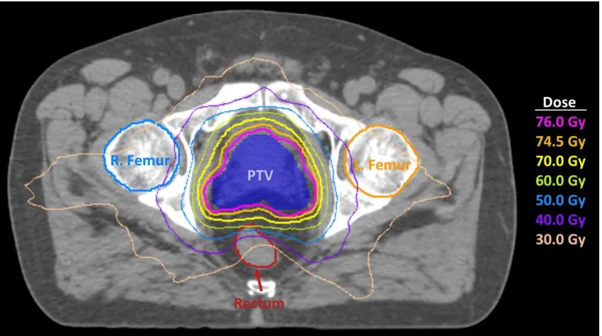 Figure 1.3: Axial view of a prostate radiotherapy plan using a single 360° VMAT arc 