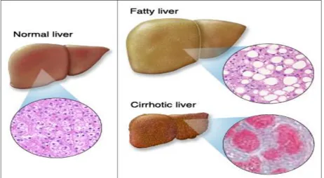 Fig.1.1 Normal versus Diseased liver 