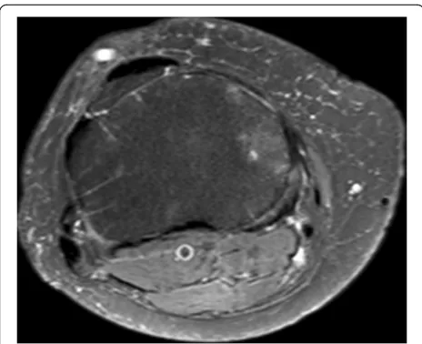 Fig. 6 Axial MRI slice with medial OA. A typical slice at level 3, rightknee, with K-L grade 2 medial osteoarthritis on plain x-ray