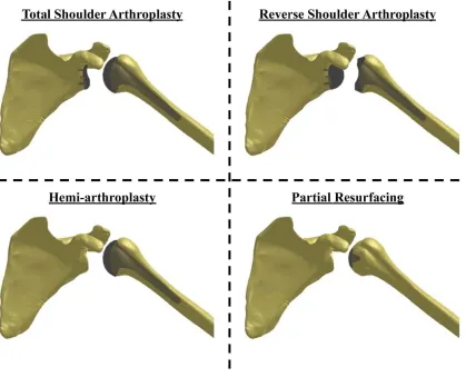 Figure 1.5 The main forms of shoulder reconstruction [51] 