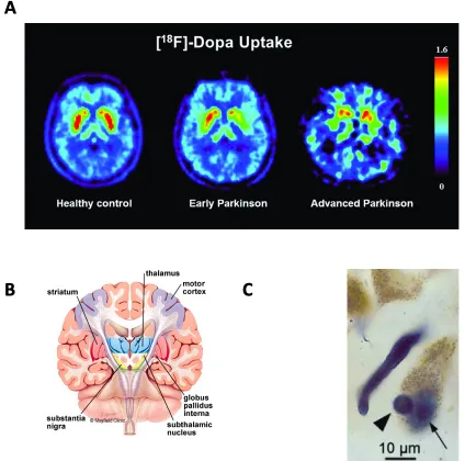 Figure 1: A PET scan displaying dopamine storage capacity in basal ganglia of an unaffected 