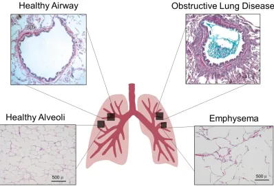 Figure 1-4: Diagram of pathophysiology of chronic obstructive pulmonary disease.  Healthy airway and obstructive lung disease panels are adapted from Hogg (2004),13 permission to reproduce provided in Appendix E