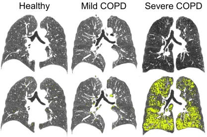 Figure 1-6: CT Imaging of healthy, mild COPD and severe COPD individuals.  