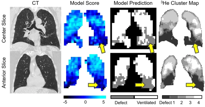 Figure 2-4: CT, Model predicted score, model binary prediction and 3He cluster map for a test subject showing representative centre and anterior slices