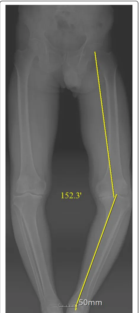 Fig. 1 Preoperative long-standing anteroposterior radiograph of apatient with severe varus knee and marked medial bone loss