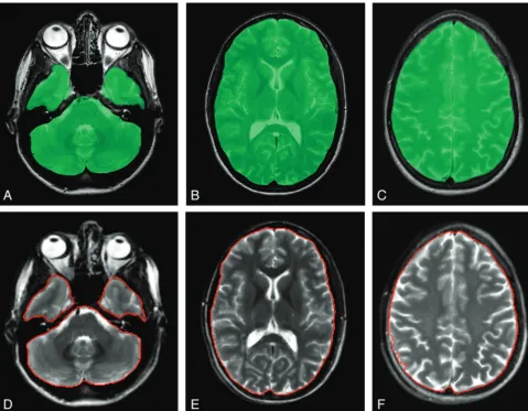 Fig 1. Typical sections of the reference method (A–C) with the QBrain software and the automatic method with the SyMRI software (D–F)