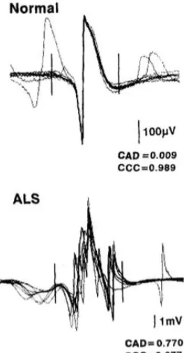 Figure 1: Schematic representing the significantly increased shape variability or 