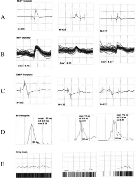 Figure 3: Summary screen displaying MUP template (A), shimmer plot (B), 